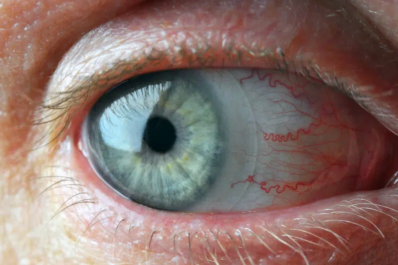 Reduce dry eyes with the right contact lens